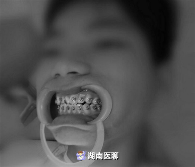 青少年牙齿正畸黄金期驾到！矫正牙齿分几步走？