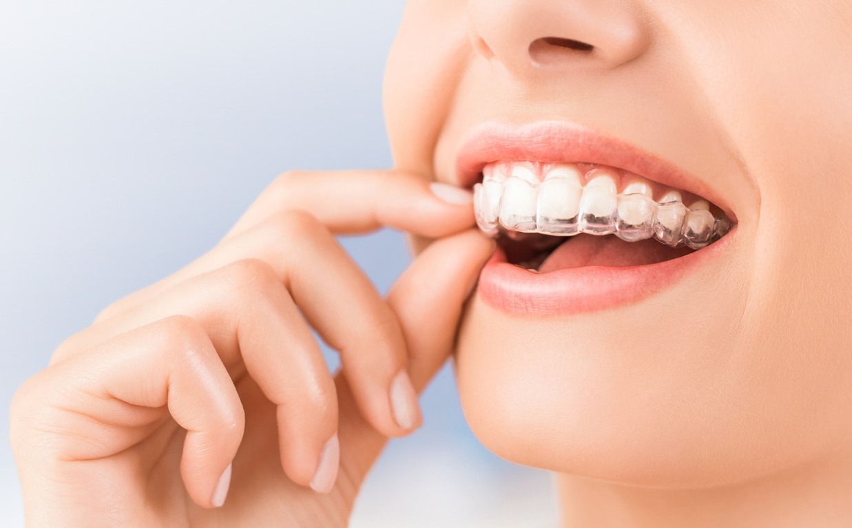 隐形牙齿矫正！不轻易被人发现的牙齿矫正方式