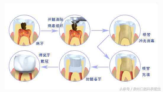 什么是牙齿根管治疗 哪些牙齿需要做根管治疗