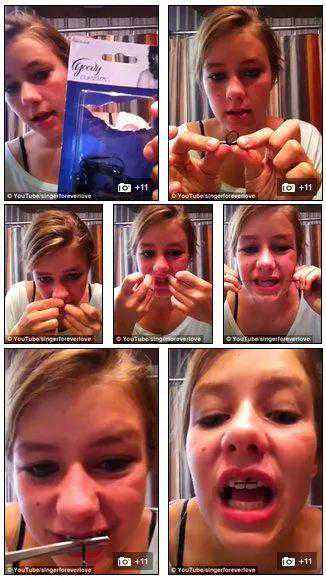 听妈妈的话橡皮筋绑牙齿代替正畸？牙齿不保