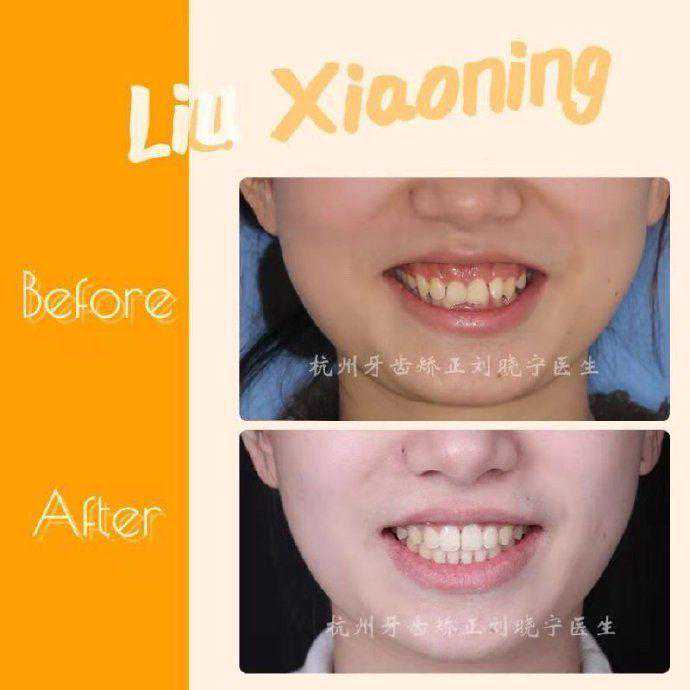 杭州舌侧牙齿矫正科普丨深覆合矫正戴舌侧牙套，矫正时间会更快