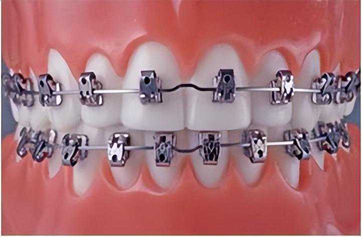 整牙堪比整容？大龄整牙经验分享