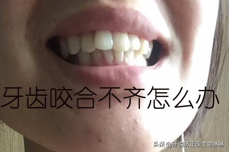 牙齿正畸不拔牙的多吗？不拔牙会影响结果吗