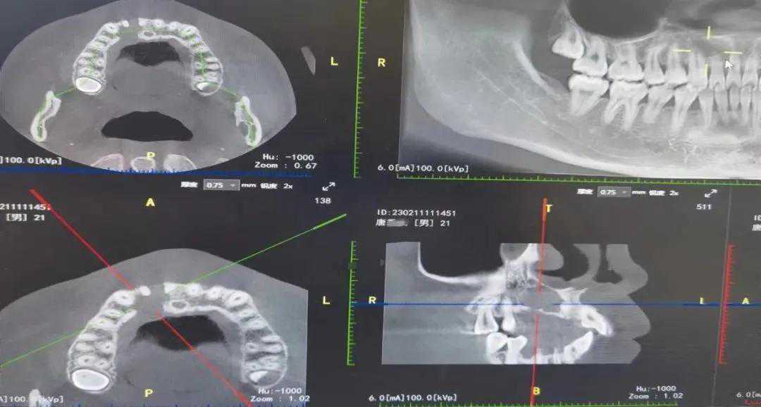 山东大学口腔医院援疆专家助力喀什地区疏勒县人民医院完成首例根尖倒充手术