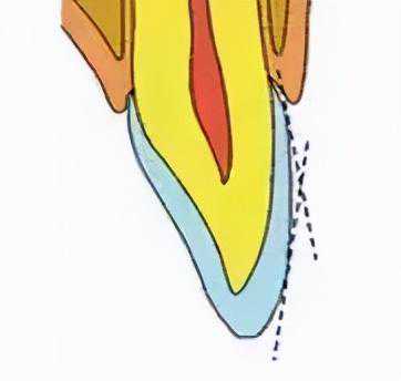 牙齿贴面的预备方法#雅悦齿科#