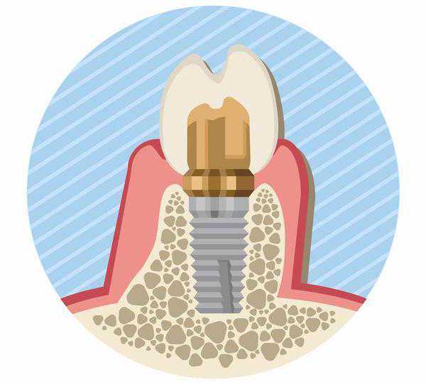 爱牙日｜牙齿也能“种”出来，这里有份种植牙攻略