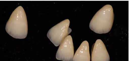 什么是全瓷牙？终于知道为什么牙医叫您选择全瓷牙