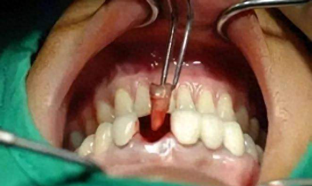 一颗坏牙一疼起来太难受？2024拔牙必看！拔牙最新价格参考