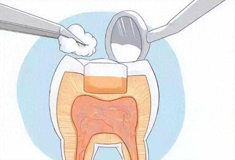 智齿龋坏到底是要拔牙还是补牙？