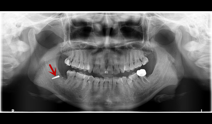深圳女子拔牙后20天不消肿，拍片一看，拔牙工具断在牙窝里