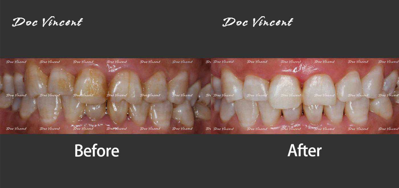 请不要再因为氟斑牙而苦恼了，牙医为你解答什么是氟斑牙