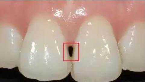 牙龈出现"黑三角"，频繁塞牙还难看！都是因为你对牙齿做了这些