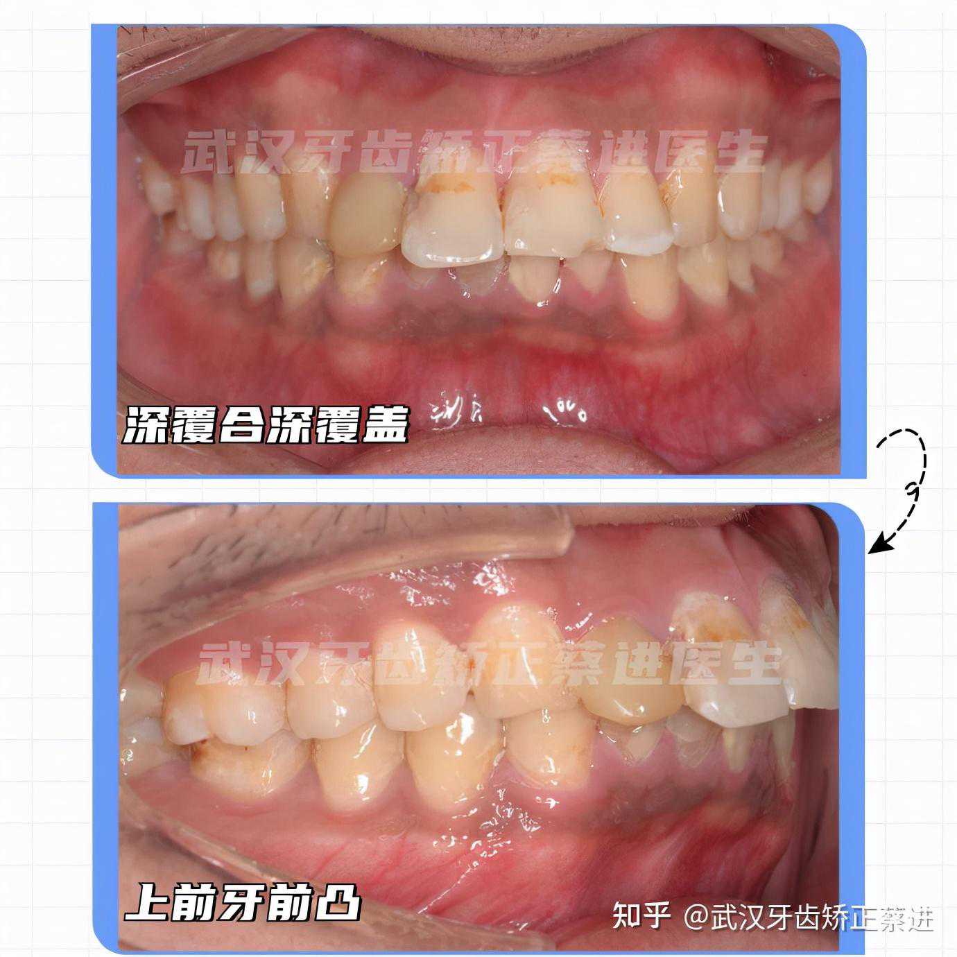 武汉牙齿矫正丨正畸中不拔牙矫正，如何内收牙齿，维持饱满面型？