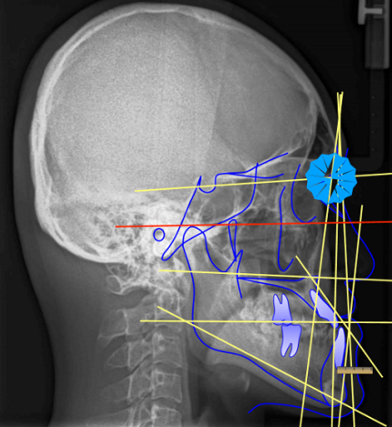 骨性龅牙一定要手术改善么？如何判断你的龅牙是骨性还是牙性？