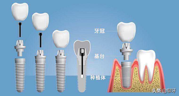 什么是种植牙？来看看做种植牙的全过程，记得平时要好好保护牙齿