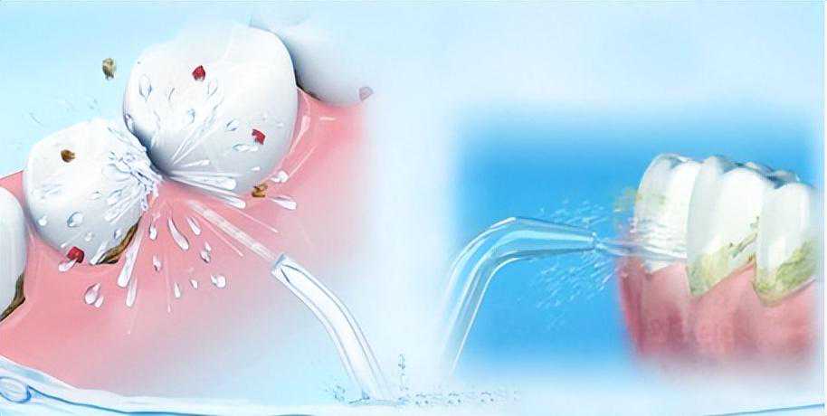 什么是喷砂洗牙？和超声波洗牙有何区别？