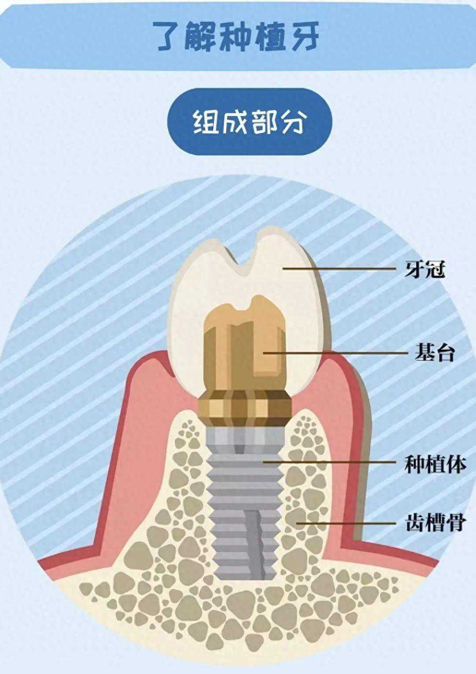 种好一颗牙的全流程，看完能安心种牙啦→