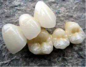 什么是全瓷牙？