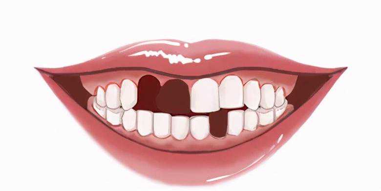 揭秘 |  种牙就像“拧螺丝钉”？种植牙到底是怎么“种”的？