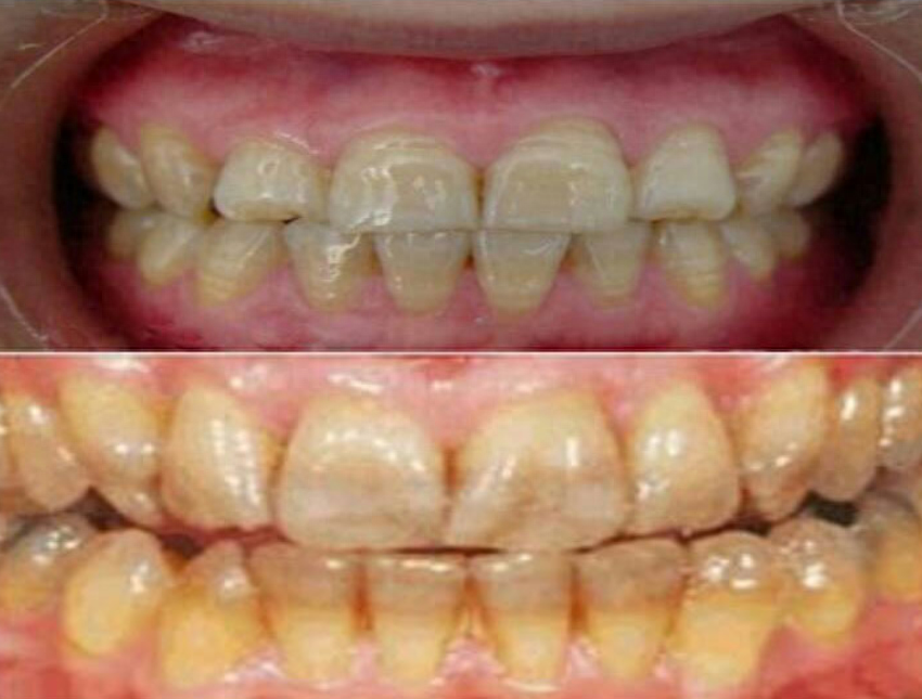 四环素牙是什么？