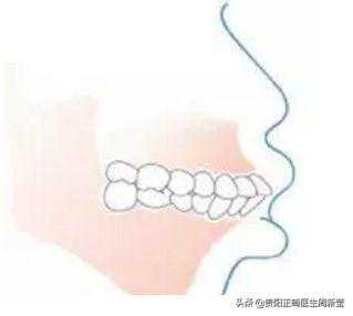 牙齿矫正只是把牙齿排齐？错！调整咬合功能才是关键