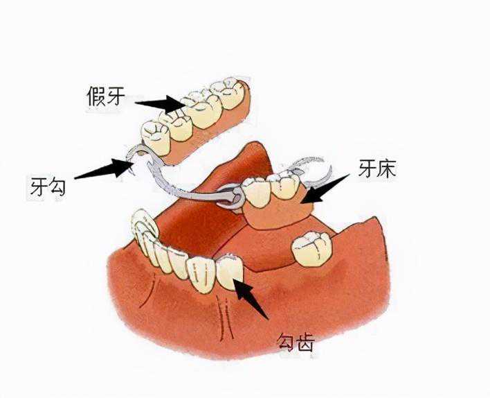 不懂假牙的正确佩戴和维护，你的假牙戴着痛！戴不久