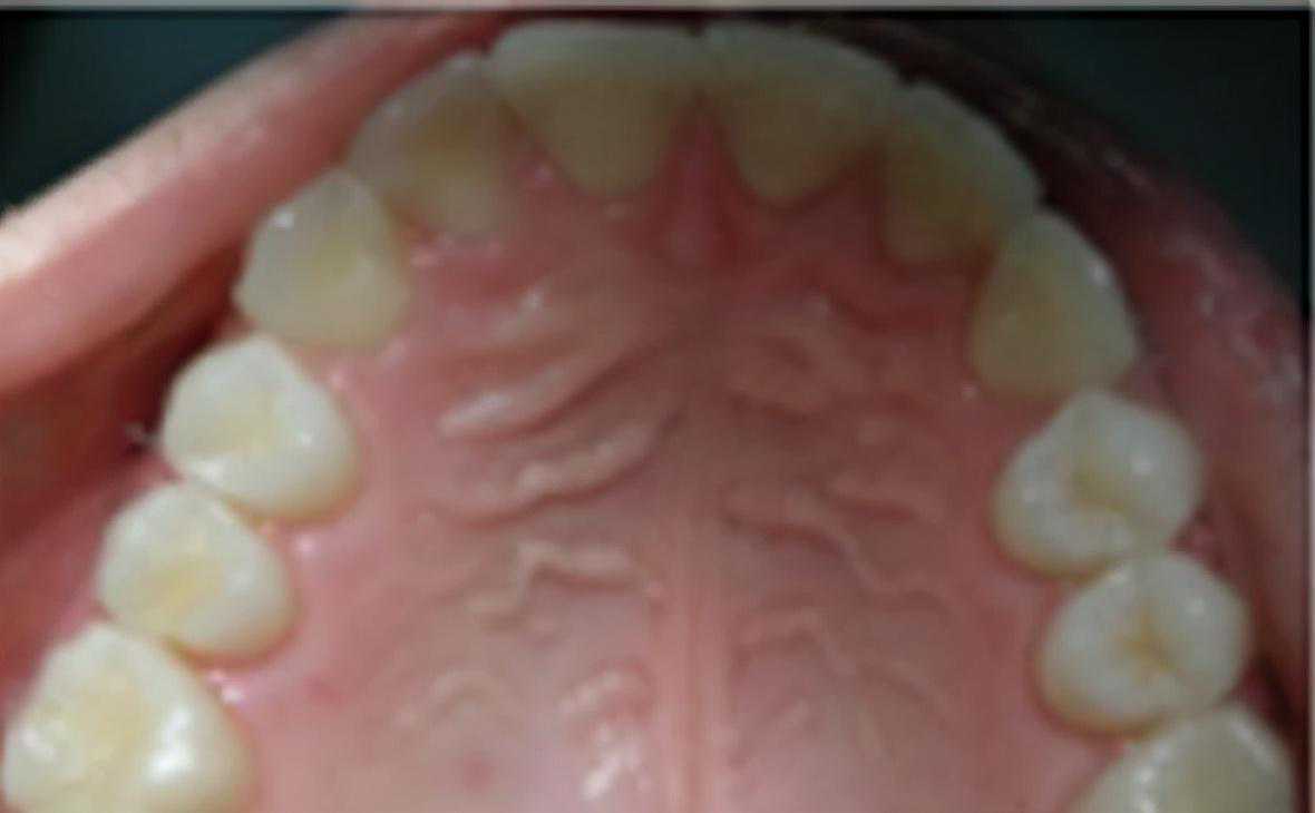 为什么牙齿会发黄？如何美白牙齿？这2种方法帮助你