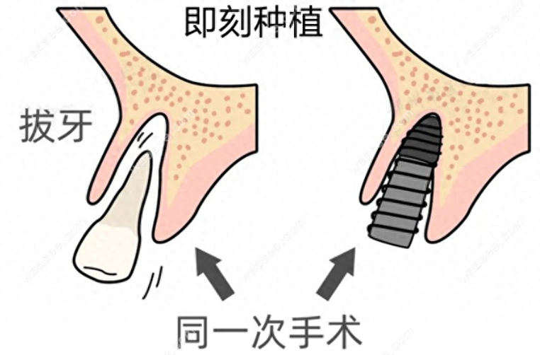 谈一谈即刻种植牙