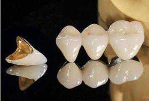 镶牙的种类有哪些？