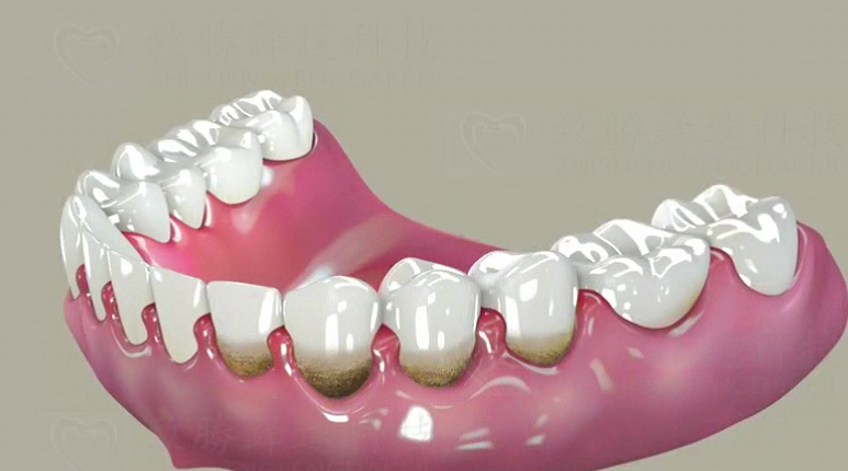 牙周炎怎么治疗呢？