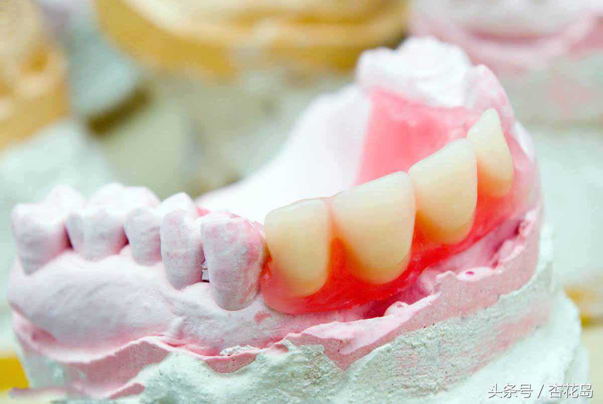 假牙的成本是多少？