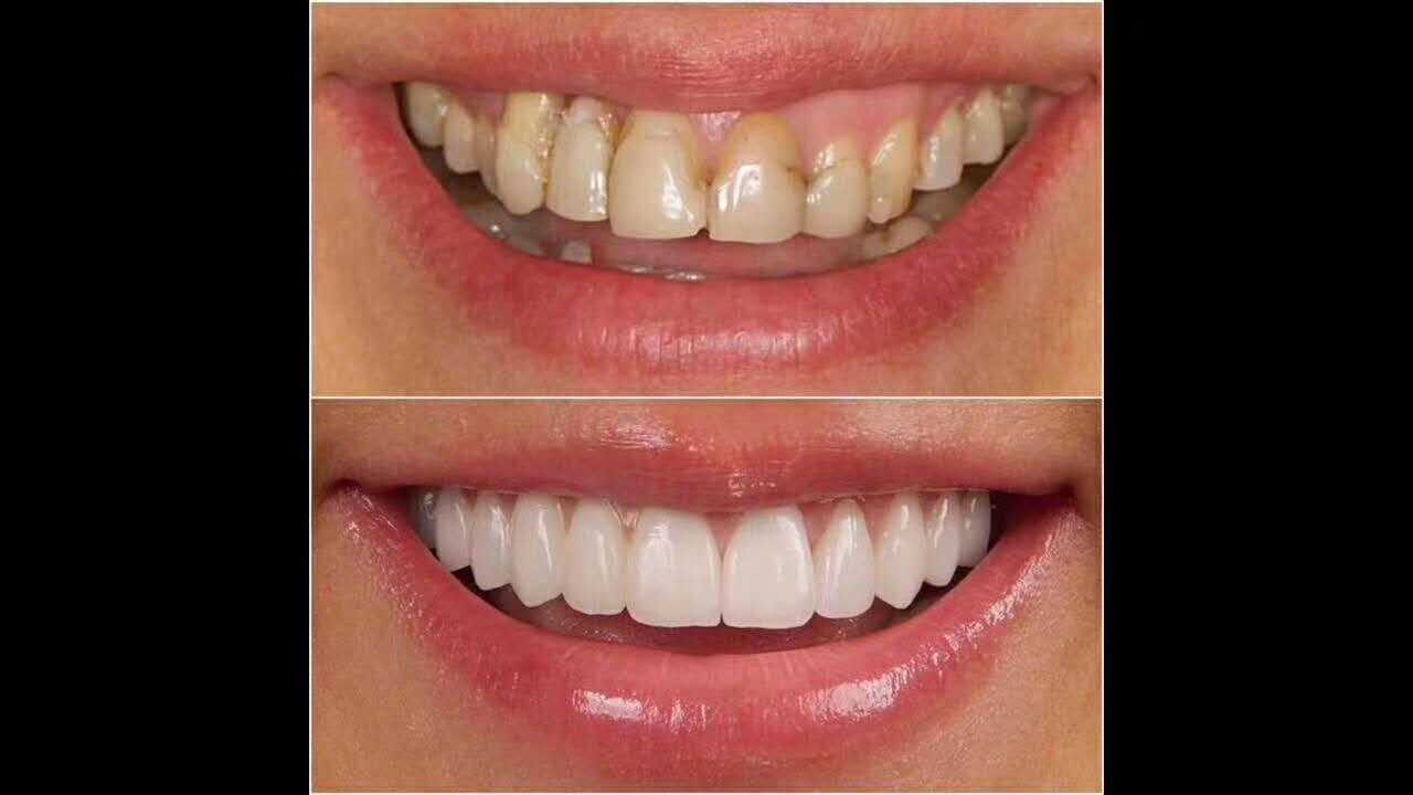 带你去认识全瓷牙