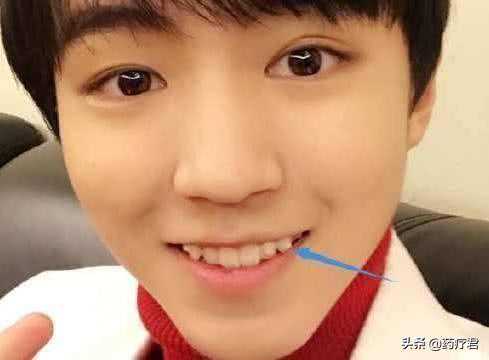 人为什么会长虎牙？有人说长虎牙的人有点“虎”，你认可吗？